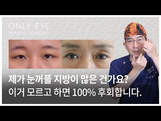 눈두덩이, 눈 지방 제거 고민이시라면? | 눈성형만 하는 온리아이성형외과 - Youtube